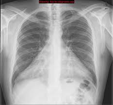 Pericardial Effusion | Radiology Reference Article | Radiopaedia.Org