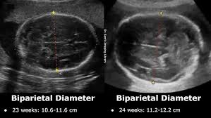 Perinatal Outcome In Fetuses With Isolated Short Femur Length Compared... |  Download Table