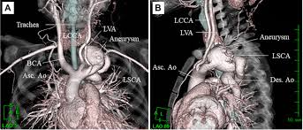 Aortic Arch Tortuosity, A Novel Biomarker For Thoracic Aortic Disease, Is  Increased In Adults With Bicuspid Aortic Valve - Sciencedirect