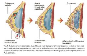 Capsular Contracture Treatment In Paramus, Nj – Parker Center For Plastic  Surgery