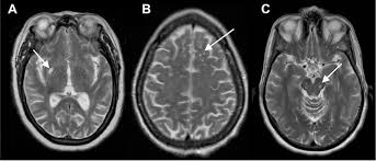 Dilated Virchow-Robin Spaces | Radiology Case | Radiopaedia.Org